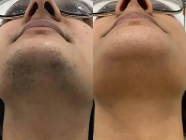 "Hormonal hair is GONE"