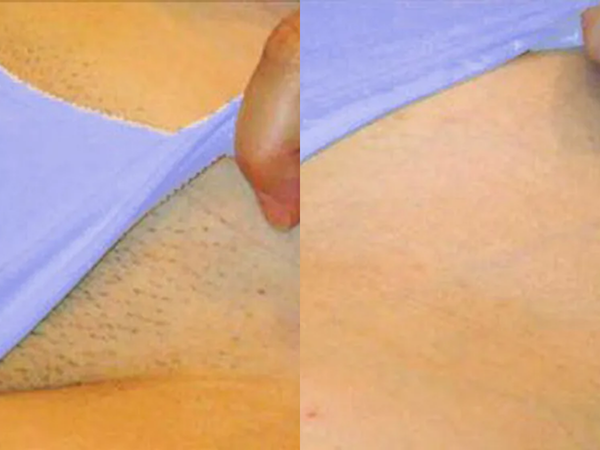 "Best for sensitive areas"